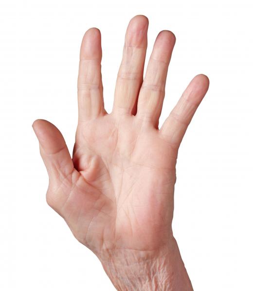 A hand with osteoarthritis in the thumb.