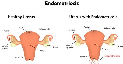 Many health experts think retrograde menstruation is to blame for the appearance of endometriosis.