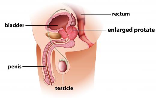 A prostate massage may be helfpul for men suffering from prostate inflammation.