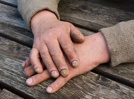 White fingernails, lower left, can signal the beginning of a fungal infection, upper center.