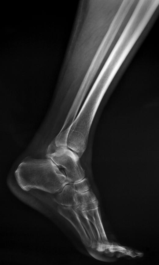 X-rays may be taken to determine the extent of damage caused by a torn ankle ligament.