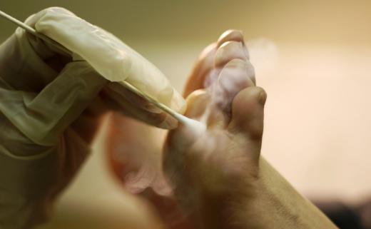 Wart removal with liquid nitrogen.