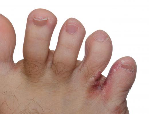 Itching, burning feet is often cause by athlete's foot.