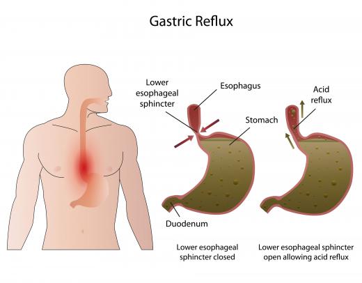 Acid reflux in which stomach acids reach back into the esophagus can be the cause of brown saliva.