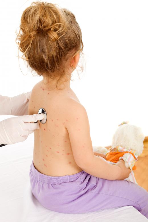 A girl with chickenpox.