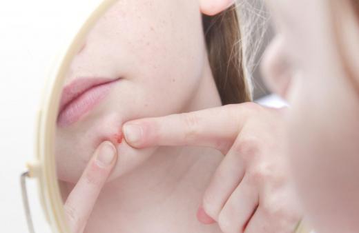 Clear pus-like fluid can often be seen around pimples when they are squeezed.