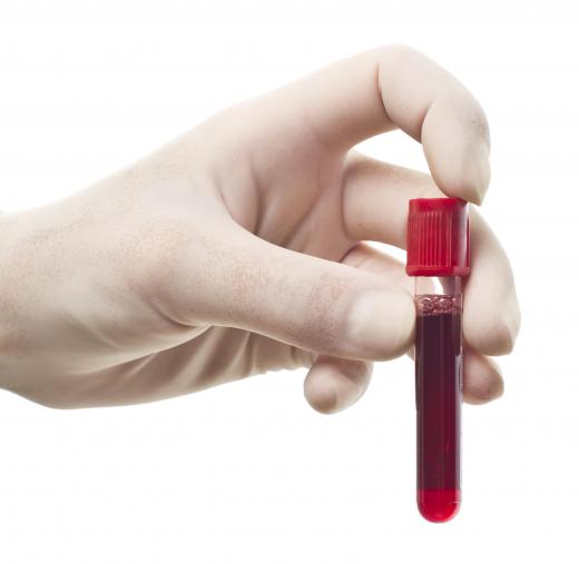 The CA-125 blood test will measure a woman's elevated risk for ovarian or reproductive cancers.