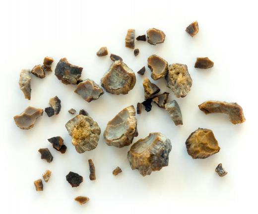 When the body’s xanthine oxidase is overactive, kidney stones may form.