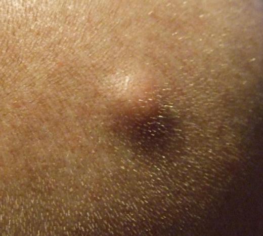 A sebaceous cyst on a scalp.