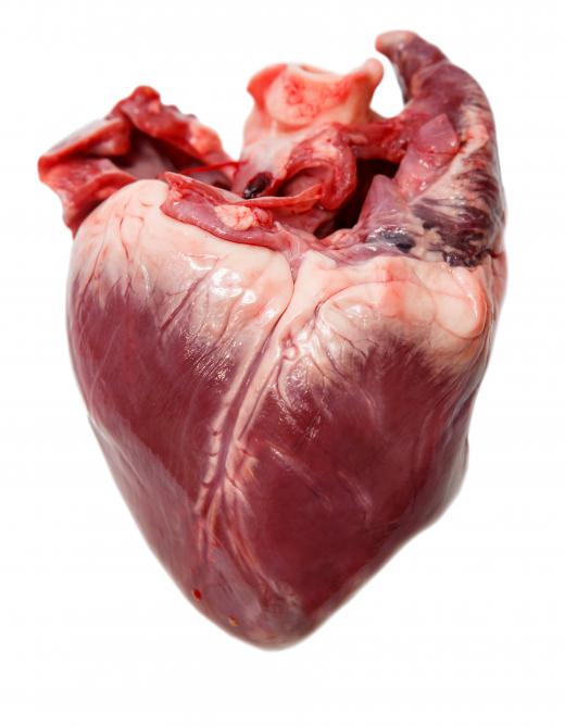 A heart transplant surgery involves replacing a damaged heart with a healthy donor heart.