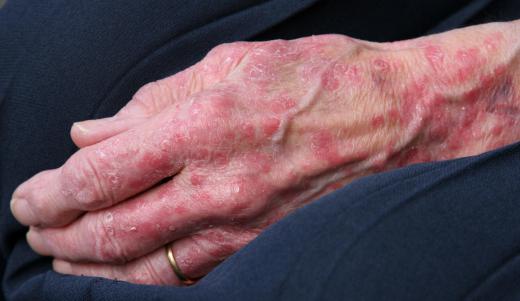 Signs of an allergic reaction to aspirin may include hives.