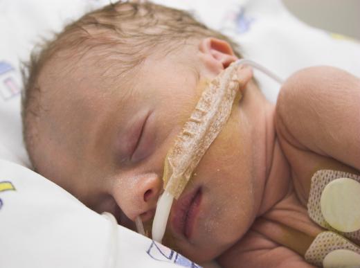 Babies born with diaphragm hernias may need supplemental oxygen, a ventilation or ECMO in the NICU.