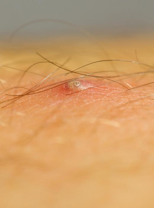 Boils can form as a result of ingrown hairs.