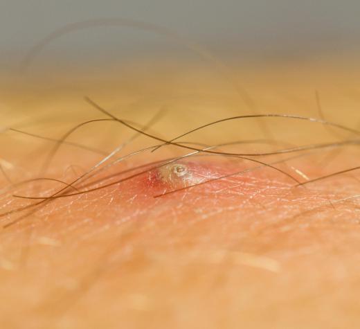 Pilonidal abscesses are often be caused by ingrown hairs.