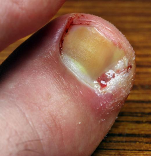 Most chiropodists are capable of removing an ingrown toenail or teaching patients how to better treat their nails.