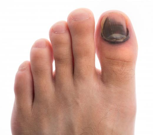 Toenail discoloration is one symptom of a toenail melanoma.