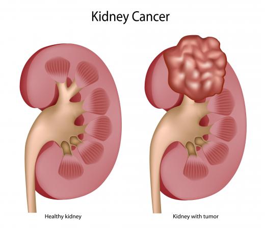 An example of a healthy kidney and one with tumors, a type of kidney mass.