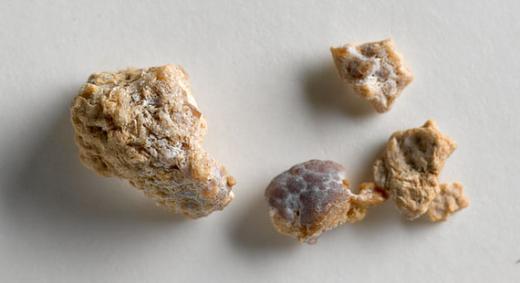 Renal stones.