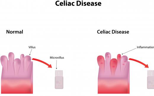 A protein known as the endomysial antibody is often used to test for celiac disease.