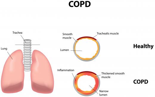 Emphysema is a form of chronic obstructive pulmonary disease (COPD), which involves enlarged air spaces and destroyed alveoli in the lungs.