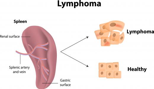 Lymphoma is a possible cause of abnormal lymphocytes.