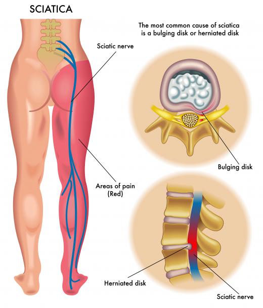 Gluteus pain may be a sign of sciatica.