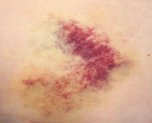 Ecchymosis is the medical term for a bruise that measures over one centimeter in diameter.