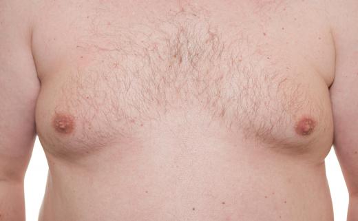 Men with high estrogen levels are at risk of breast gynecomastia.