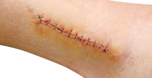 Stitches are used to close surgical wounds.