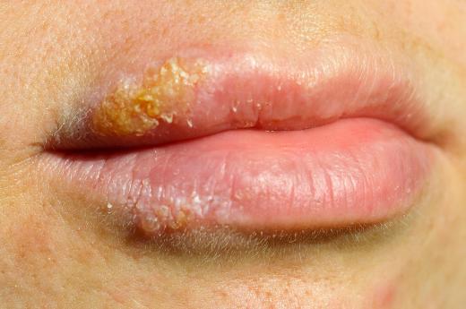 In some cases, kissing someone with herpes simplex 1 can cause an outbreak in the throat.