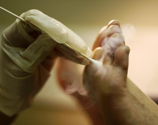 A dermatologist might use liquid nitrogen to remove a wart.