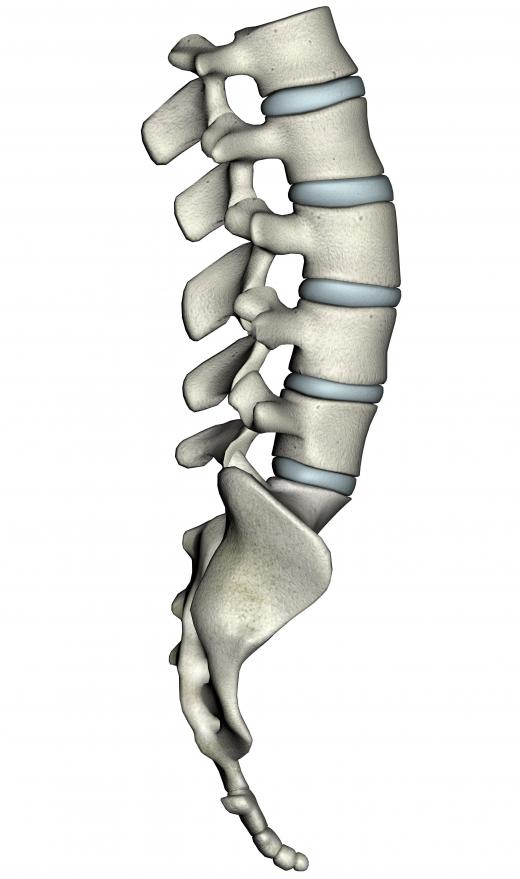 Disc extrusion happens when a disc in the spinal column breaks through its fibrous enclosure.