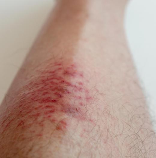 A red rash at the area around the bite could be a sign of an allergic reation to fleas.