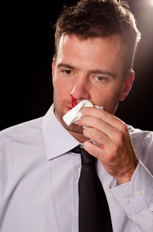 A bloody nose is an example of externalized hemorrhaging.