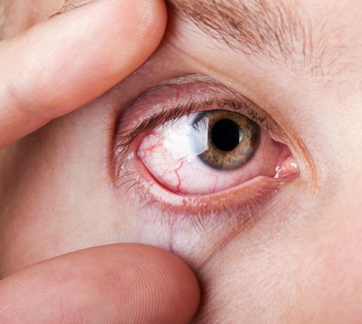 Xerophthalmia is a medical term for dry eye.