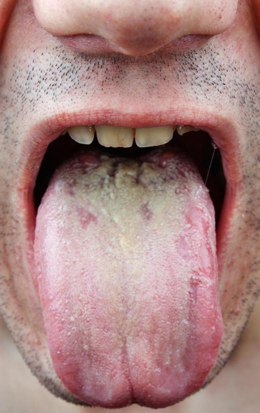 Thrush is a fungal infection that affects the mouth and tongue.