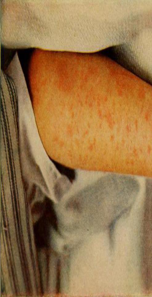 Patients with bier spots can develop the appearance of mottled skin.