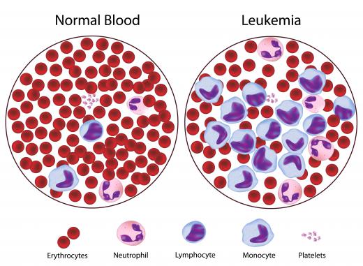 Samples of blood from a healthy person and one with leukemia, showing an increase in the numbers of white blood cells.