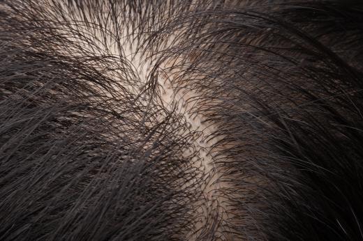 Sebaceous glands are most prevalent in the skin of the scalp.