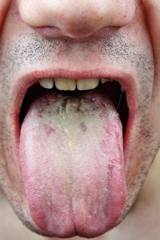 Candida is the common culprit behind oral thrush.