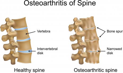 An illustration of a healthy spine and one with spinal osteoarthritis. Many individuals believe that glucosamine, taken with chondroitin, may help people with osteoarthritis.