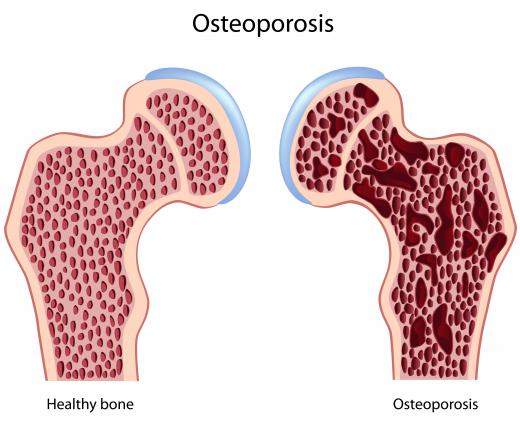 Osteoporosis occurs when bone density decreases.