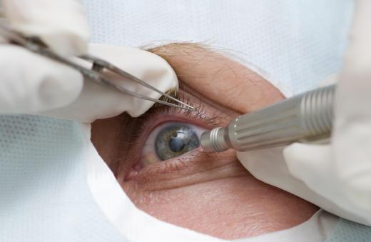 Patients who get LASIK treatment can develop corneal ectasia, or swelling of the cornea.