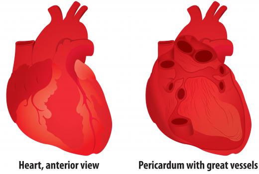 Cardiac tamponade refers to a collection of blood in the pericardium causing compression.