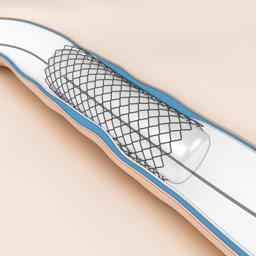 A stent is a supportive device inserted into the body.