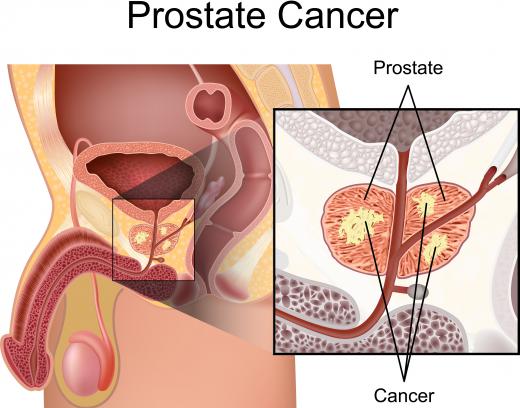 Acinar adenocarcinoma is the cause of roughly 90% of prostate cancer cases.