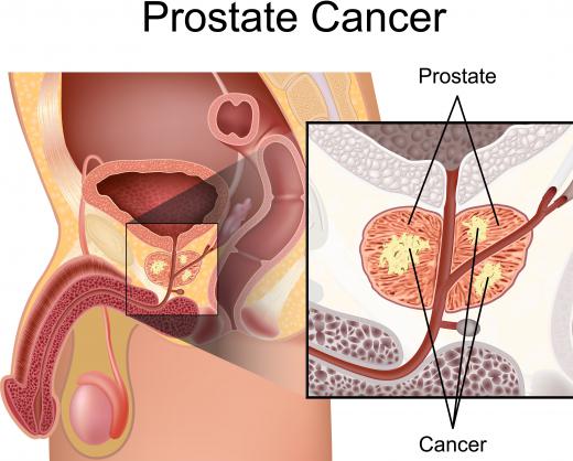 Prostate cancer almost always appears as a hypoechoic lesion on an ultrasound.