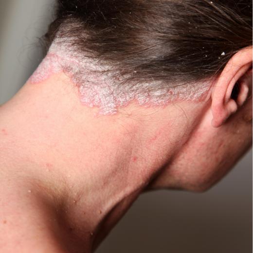 Psoriasis affects skin all over the body.