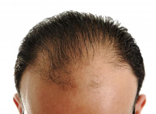 Receding hairline.