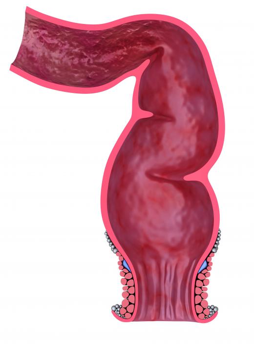 A fistula is an oppening beneath the skin often running between the glands of the rectal cavity.